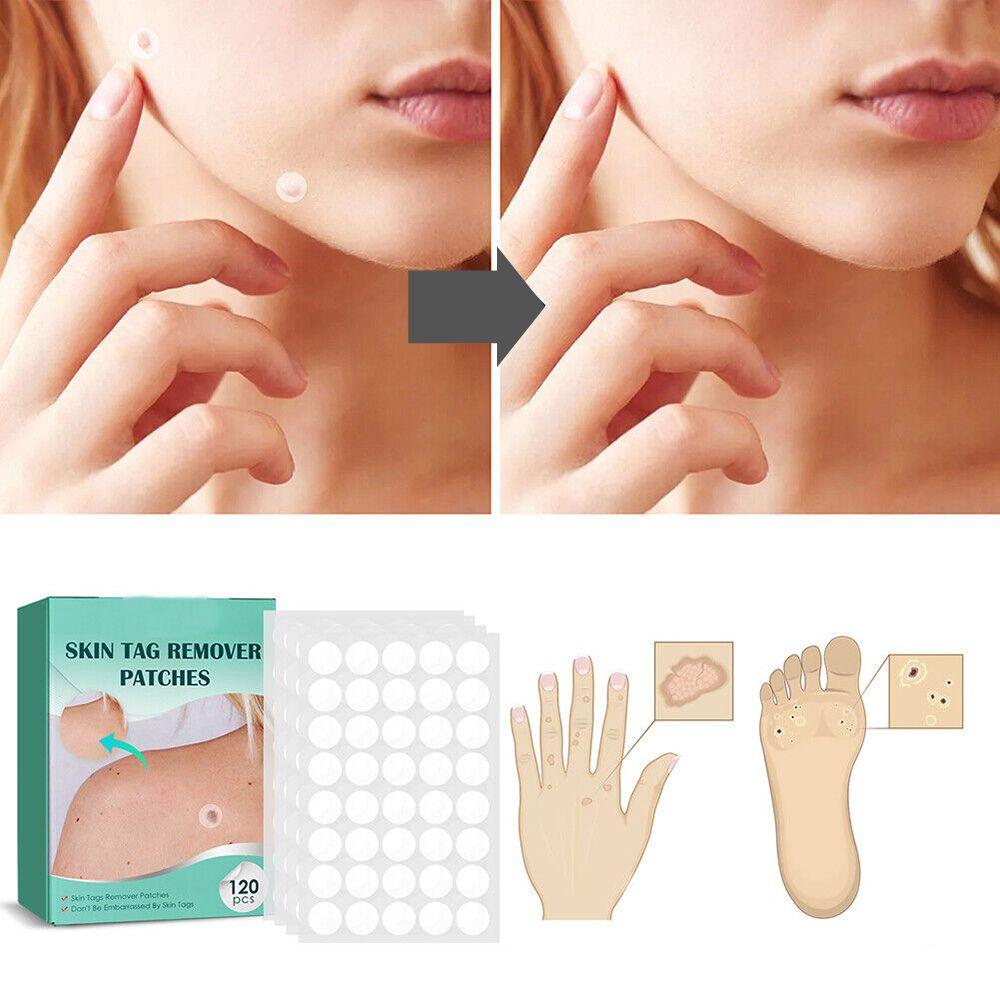 Skin Tag & Wart Removal Patches - Painless Sensitive Treatment