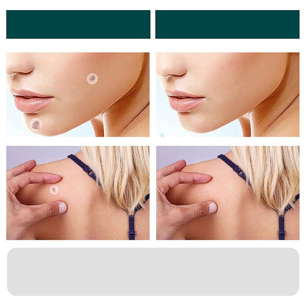 Skin Tag & Wart Removal Patches - Painless Sensitive Treatment