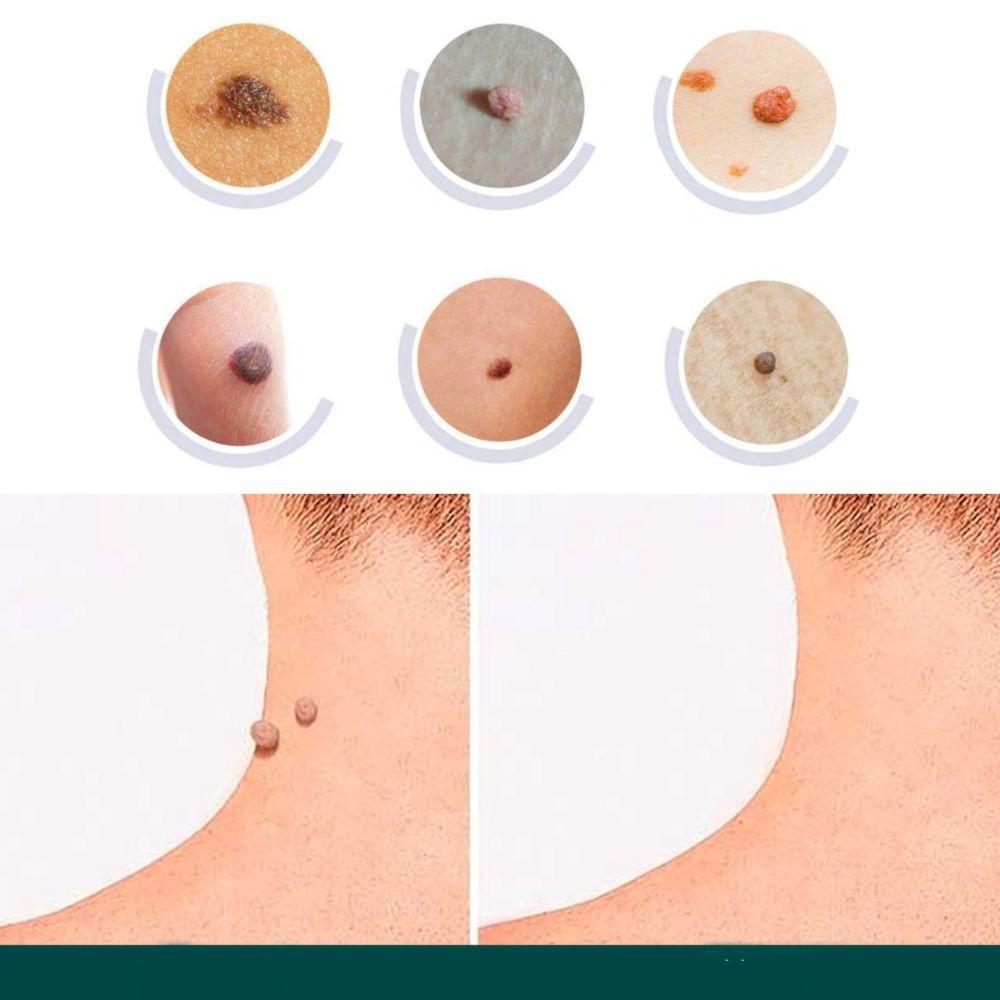 Skin Tag & Wart Removal Patches - Painless Sensitive Treatment
